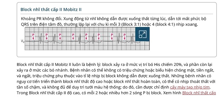 Block-nhi-that-cap-do 2- Mobitz-II-Nguon msdmanuals-com